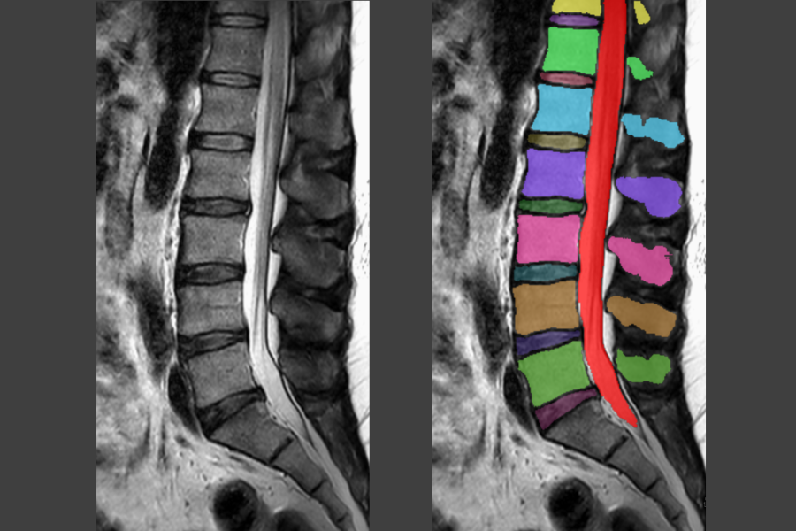 Beknelde zenuw of scheefstand: AI vindt de oorzaak van lage rugpijn